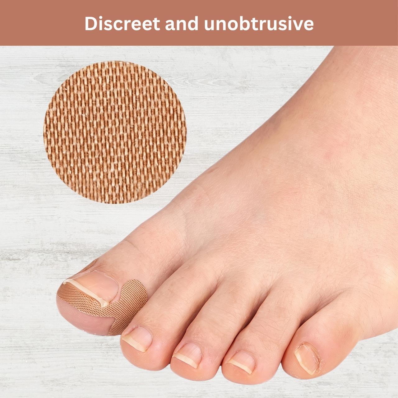 Ingrown Toenail Correction Patches, ProPatches - Image 10
