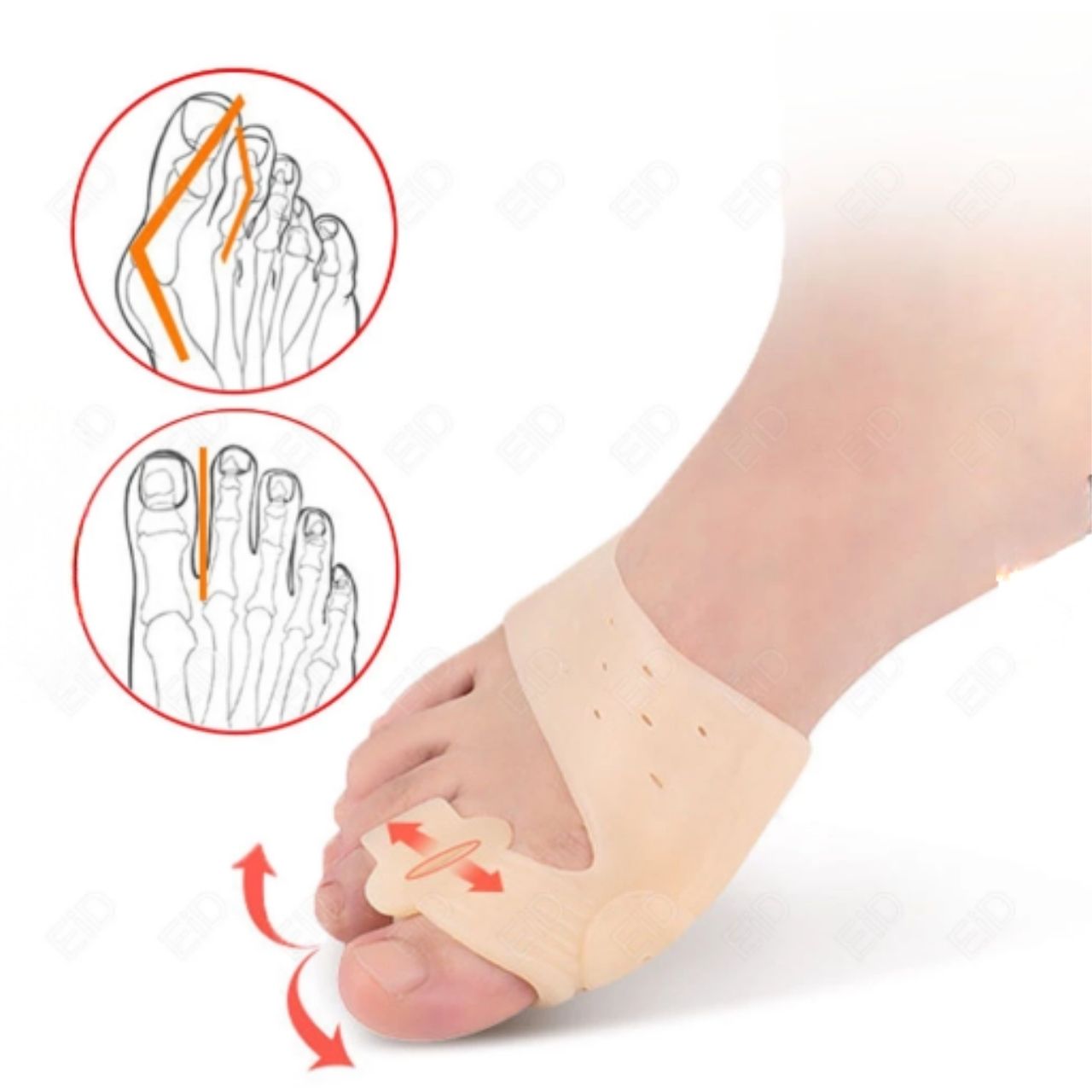 ToeCorrect, a brace for toe correction